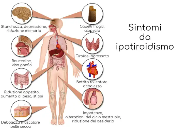 Ipotiridismo: stanchezza, depressione, problemi di memoria, ingrossamento della tiroide e altri sintomi.