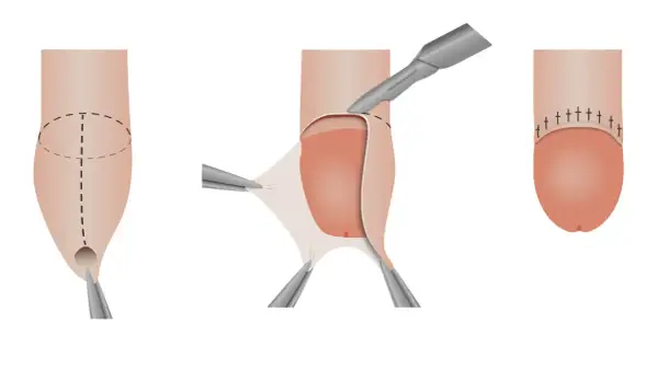 Illustrazione di un pene non circonciso durante un intervento chirurgico, con rimozione del prepuzio e sutura.