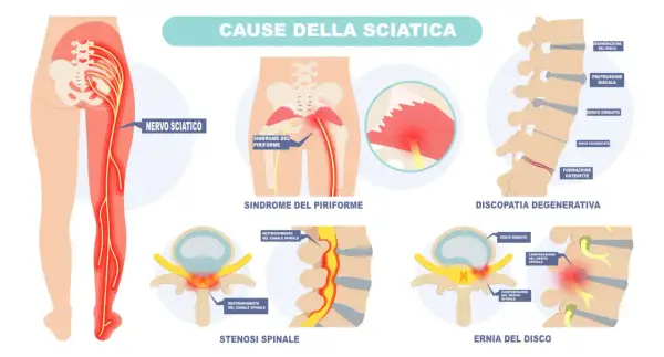 Illustrazione delle cause della sciatica: nervo sciatico infiammato, sindrome del piriforme, discopatia degenerativa, stenosi spinale ed ernia del disco.