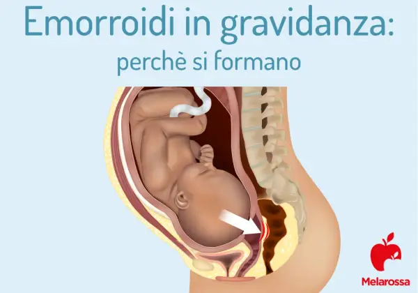 Illustrazione anatomica che mostra il feto nell'utero e la causa delle emorroidi in gravidanza, con un'area evidenziata.