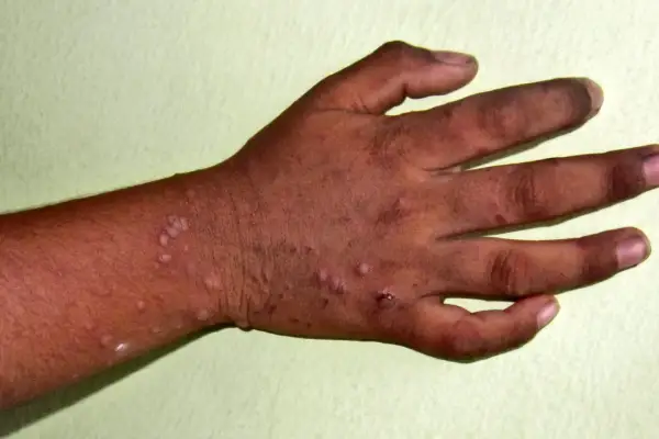 Mani e avambraccio con lesioni cutanee, possibili sintomi di una malattia che colpisce mani, bocca e piedi.