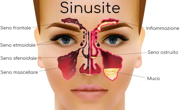 Illustrazione anatomica dei seni paranasali, evidenziando infiammazione e muco, causa comune di mal di testa da sinusite.