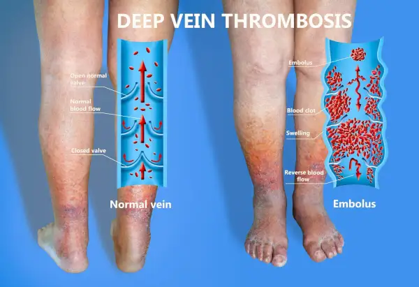 Gambe gonfie e arrossate, con un'illustrazione che mostra la flebite gamba sintomi: un trombo blocca il flusso sanguigno.