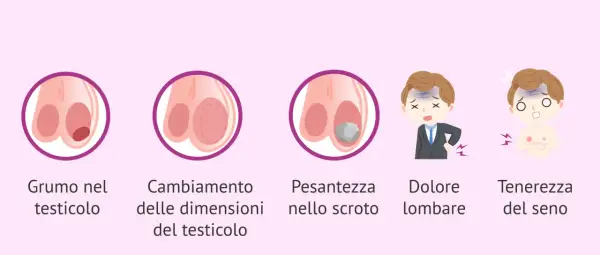 Illustrazione di sintomi: nodulo, cambiamento dimensioni testicolo, pesantezza scroto, dolore lombare, tenerezza seno. Possibile dolore testicolo sinistro.