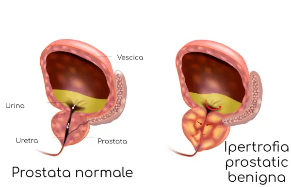 Confronto tra prostata normale e prostata ingrossata: sintomi e cure. L'ipertrofia prostatica benigna comprime l'uretra, ostacolando il flusso urinario.